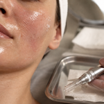 Microneedling avant après 1 séance : rougeurs 48 h sur peau au spa